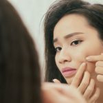 How to Prevent Acne & Pimples? 10 Tips to Avoid Breakouts