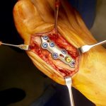 Do you Know About Removal of Orthopedic Implant?