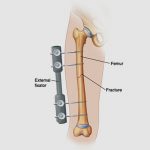 The most common kinds of femoral shaft fractures