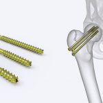Cannulated & Herbert Screws : Orthopedic Screw Types