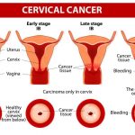 Cervical cancer in Females- the leading Cause of Death
