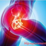 A Successful Story: Total Hip Replacement Surgery in Kalyan