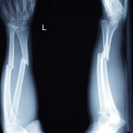 What is the symptoms and Treatments of Hand Fractures | Siiora.lk