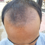 Best Hair Specialist in Udaipur|Derma Dent Clinic