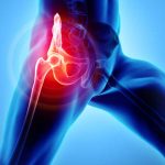 Best Hip Replacement Doctor and Hospital in India