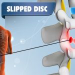 Slip Disc Treatment in Pune-Anand Gupte