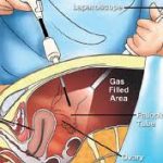 About Laparoscopic Ovarian Cystectomy