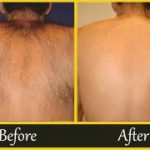Hair Transplant with specialists in Mumbai