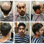Hair Bonding in Gurgaon,@https://www.lynxhairskin.com/