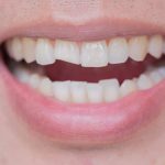 Chipped Tooth Repair Cost | East Valley Dental Professionals