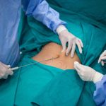 What Is The Main Things You Need To Know About Liposuction & Why It's In Trend