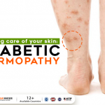 Diabetic Dermopathy and top easy ways to tackle it