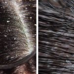 Difference Between Dandruff and Dry Scalp