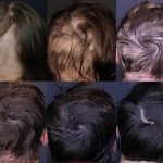 6 Ways for Hair Loss Problems by Board Certified Dermatologist at Alpha Clinic in Edmonton