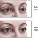 EyeLid Surgery Cost in Gurgaon