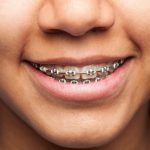 Best Orthodontist in Pune | Orthodontist in Pune | Orthodontist in Viman Nagar | Orthodontists in Kalyani Nagar – Braces & Smiles Dental Clinic