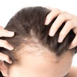 MEDICAL TREATMENTS FOR HAIR LOSS