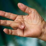 Heal Trigger Finger with Home Treatment