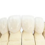 Dental Crowns vs Veneers | East Valley Dental Professionals