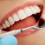 A Quick Guide: Dental Bonding Vs Veneers