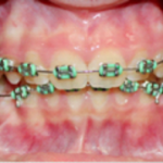 Top Braces, metal and clear treatment in Fort Washington