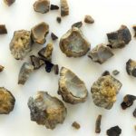 Cystine Stones | Kidney Stone Types