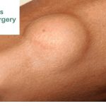 Get a Effective Lipoma Removal Naturally