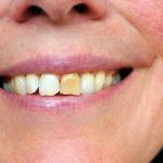 Stained Teeth Causes, Prevention, and Treatment | Mesa Dentist