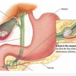 Gall bladder stone treatment in jaipur