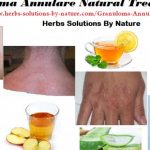 7 Effective Natural Treatments for Granuloma Annulare