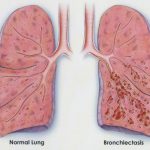 Bronchiectasis Relief can be found in Natural Treatment