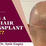 Does a FUT Hair Transplant Hurt?