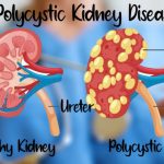 Natural Remedies for Polycystic Kidney Disease and Healthy Diet