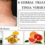 Natural Remedies for Tinea Versicolor with Helpful Home Ingredients