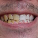 How to Get Rid of Yellow Teeth with Home Remedies