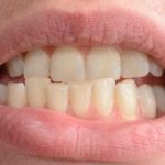 Crooked Teeth Causes and Treatment