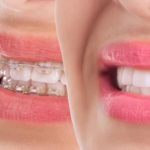 clear porcelain braces