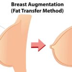 Is There Any Fat Transfer Breast Augmentation Risks?