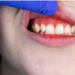 Periodontal Disease: Definition & Causes
