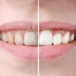Professional Teeth Whitening vs At Home Solutions | Mesa Dentist