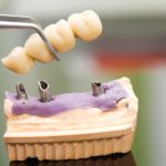 Dental Bridge vs Dental Implant | East Valley Dental Professionals