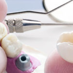 Hybrid implant denture in Virginia