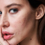 How to Distinguish Between Different Types of Acne?