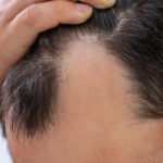 What are the main causes of hair damage/hair loss?