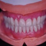Get Full and Upper Partial Denture from The Hive Dental Laboratory