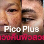 Pico Plus Laser ทวงคืนผิวสวย รักษาหลุมสิว รอยสิว ฝ้า รอยสัก ผิวไม่ตกสะเก็ด | Skin Laser | Testimonials | Siam Laser Clinic(SLC) สยามเลเซอร์คลีนิก