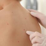 How to Prevent Chicken Pox from Becoming a Serious Illness?