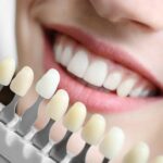 Everything You Need To Know About Teeth Whitening – Perfora