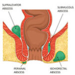 Dr. Ram | fistula surgeon in Ahmedabad