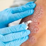 Understanding Psoriasis: Causes, Symptoms, And Treatment Options